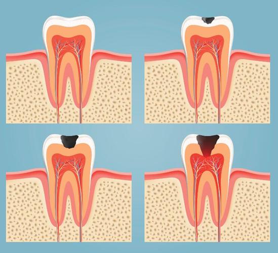 第三种常见牙病是啥？多数人竟忽视！-图3