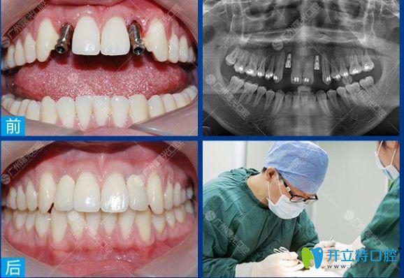 广州前十种植牙-图2