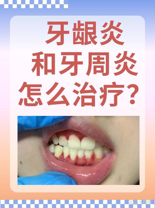 牙龈炎能种牙么-图1