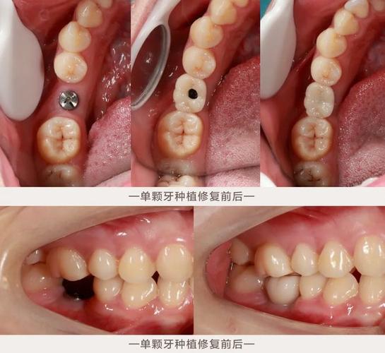 种牙全过程痛吗-图2