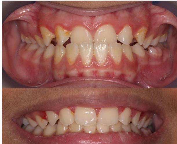 正畸期间牙齿松动严重-图1