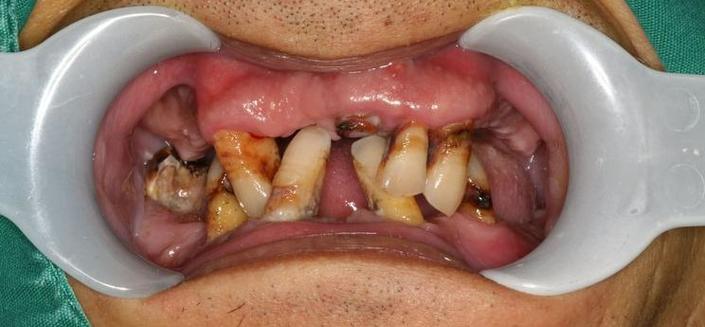 正畸期间牙齿松动严重-图2