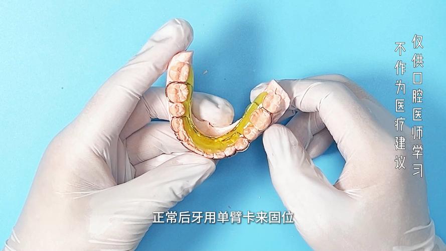 舌侧矫正方法-图2