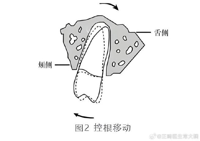 正畸控根的关键方法有哪些？-图2