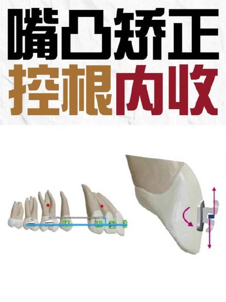 正畸控根的关键方法有哪些？-图3