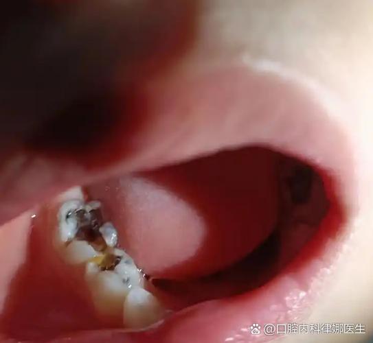 拔牙一年不种牙-图2