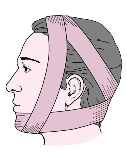 正畸吊扎方法的具体操作步骤、技巧及注意事项是怎样的？-图2