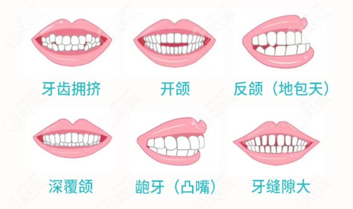 正畸2乘4技术适用于哪些错颌畸形？-图3