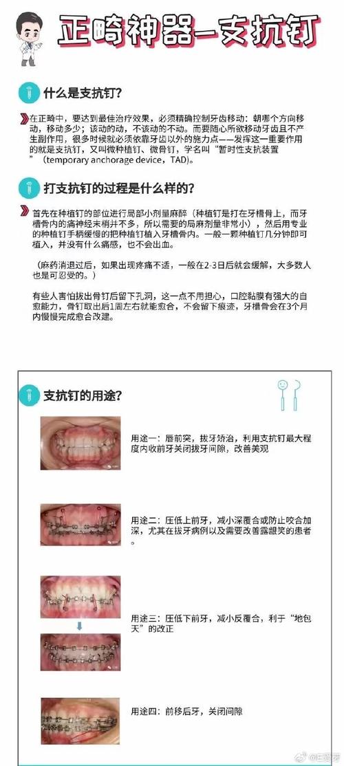 正畸去支抗钉注意事项-图2