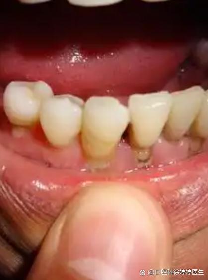 糖尿病能种牙吗-图2