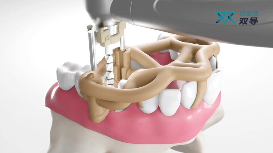数字化种牙导版，如何通过数字化指导精准种牙？-图1