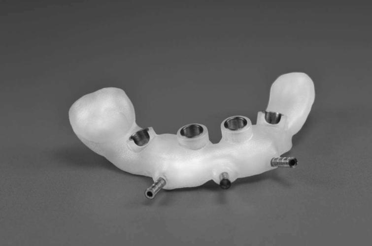 数字化种牙导版，如何通过数字化指导精准种牙？-图3