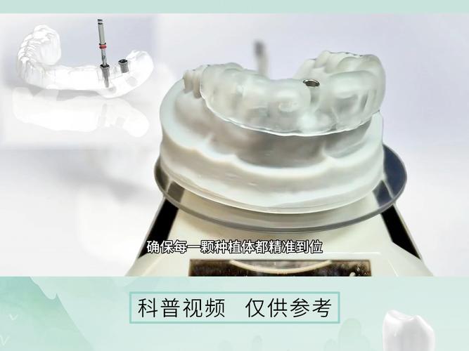数字化种牙导版，如何通过数字化指导精准种牙？-图2