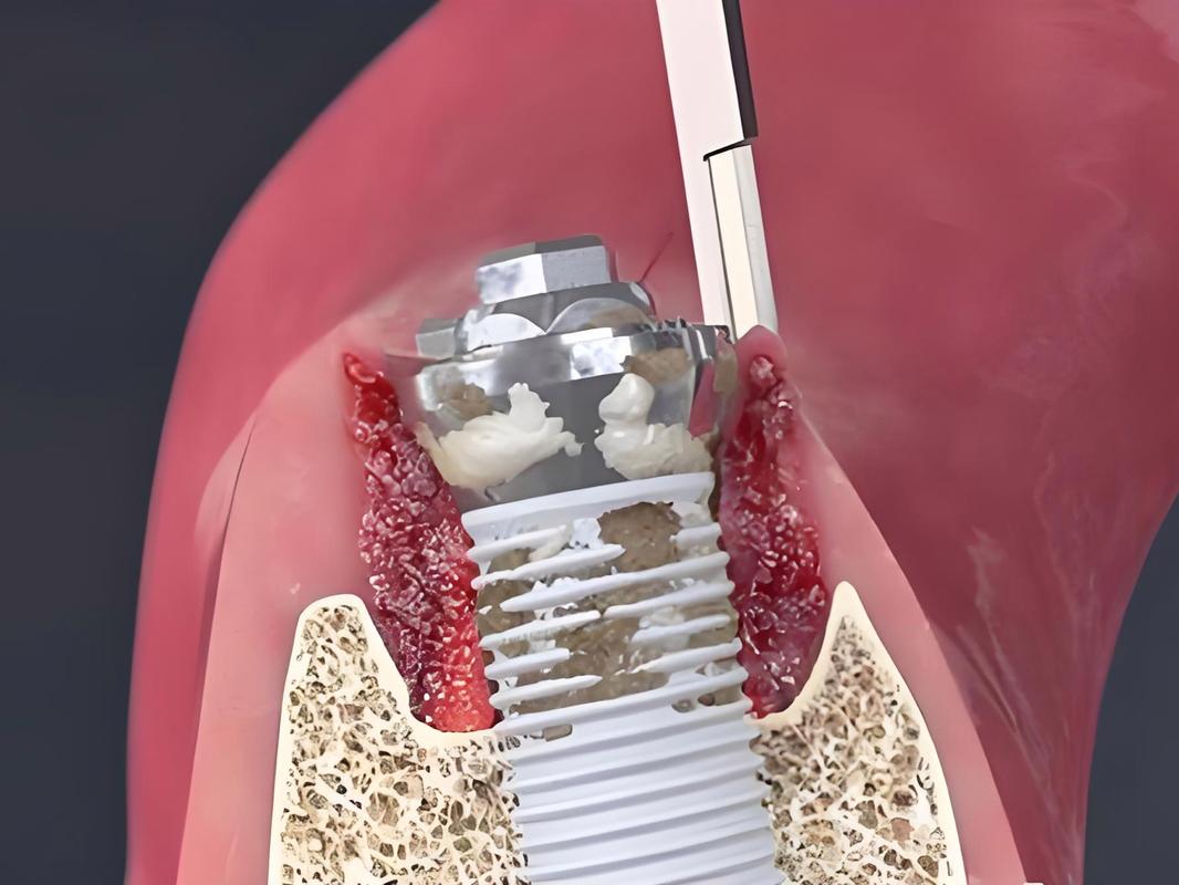 种牙打钉后很痛-图3