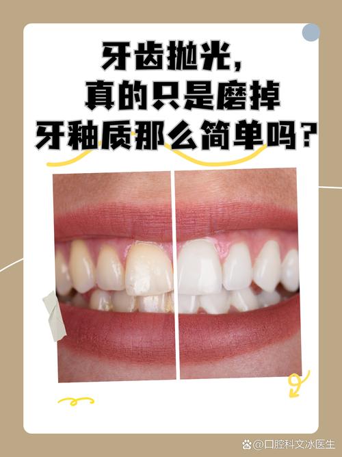 牙体抛光方法-图1 牙体抛光方法-图1