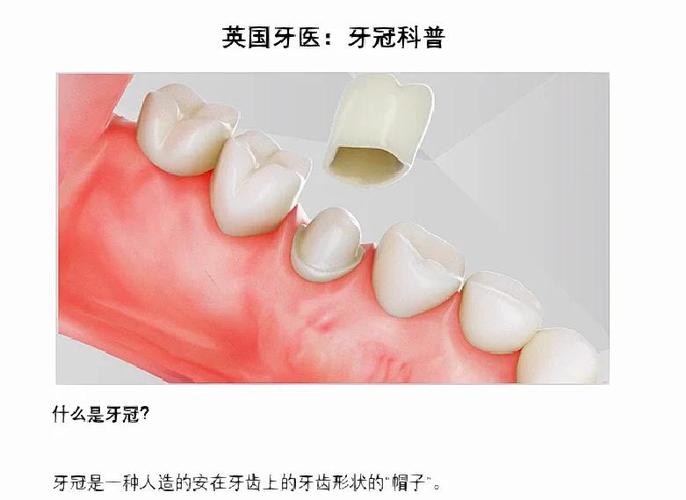 牙齿戴冠的方法有哪些?详细步骤和注意事项是什么?-图3 牙齿戴冠的方法有哪些?详细步骤和注意事项是什么?-图3