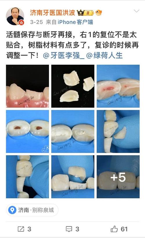 断牙再接方法-图3