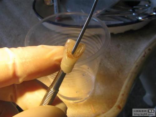 断牙再接方法-图2