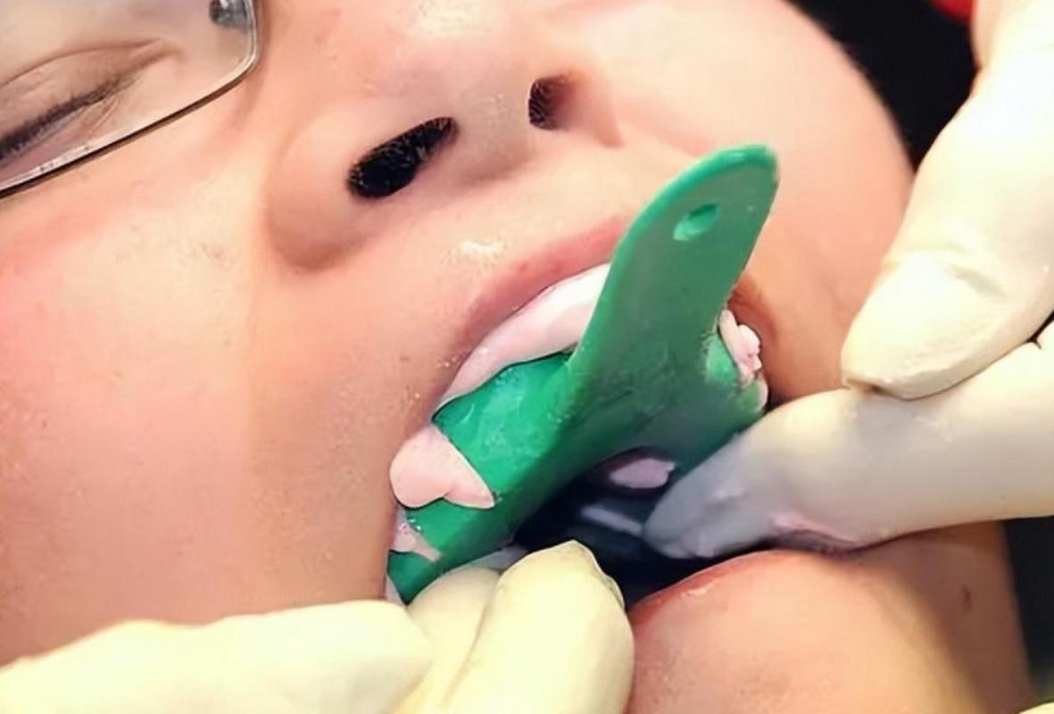 牙齿取模方法-图3