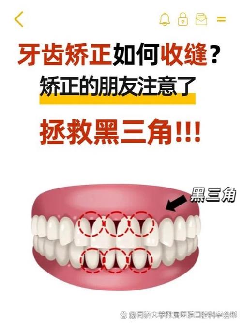 牙缝变小方法-图1