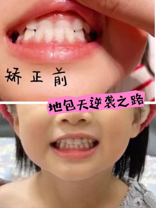 小孩骨性龅牙能正畸吗-图1