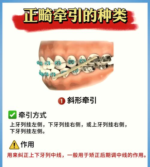 正畸牙齿带皮筋的作用-图1