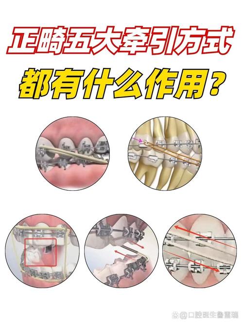 正畸牙齿带皮筋的作用-图2