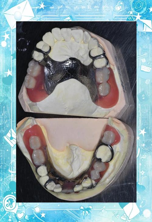 假牙取戴的正确方法与步骤是怎样的？-图3