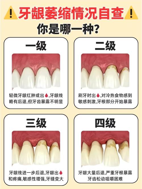 正畸后牙龈萎缩，究竟是什么原因导致的？-图2