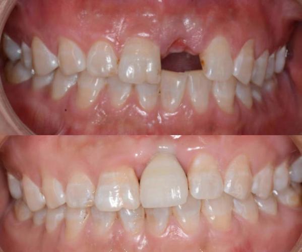 包头是昆区种牙-图1