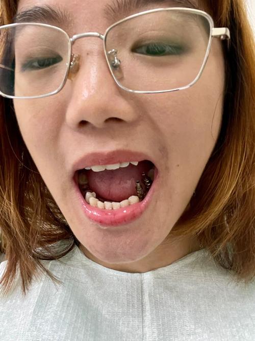 包头是昆区种牙-图3