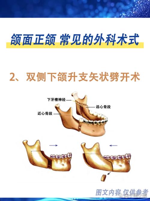 上颌手术方法-图3