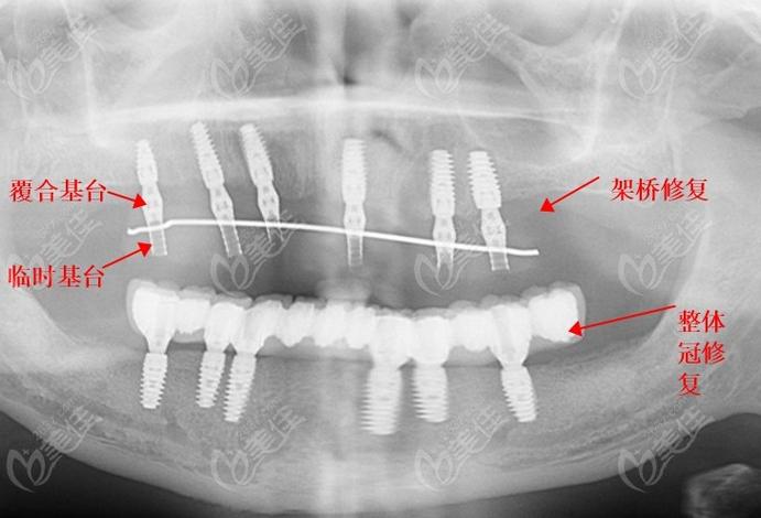 种牙桥架的应用-图2