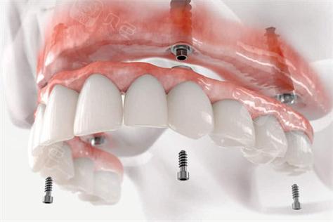 种牙桥架的应用-图3