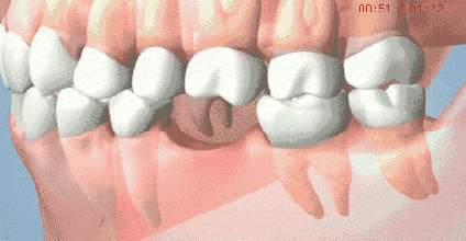 种牙过程动态图-图1 种牙过程动态图-图1