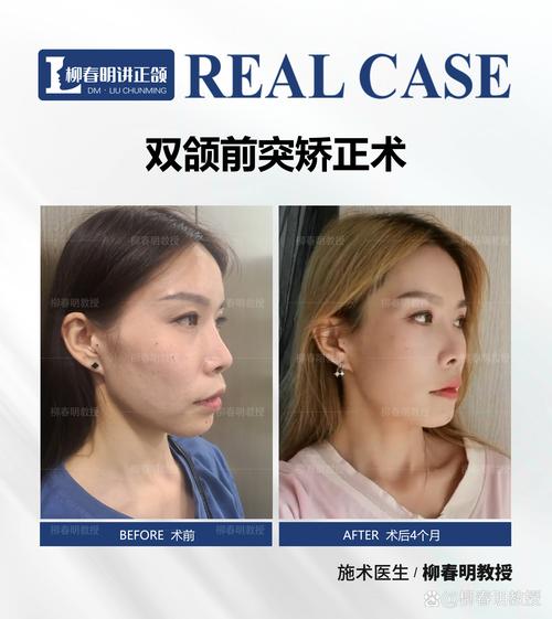 正颌手术术后正畸时间-图3