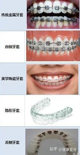 上海矫正牙齿正畸价格-图3