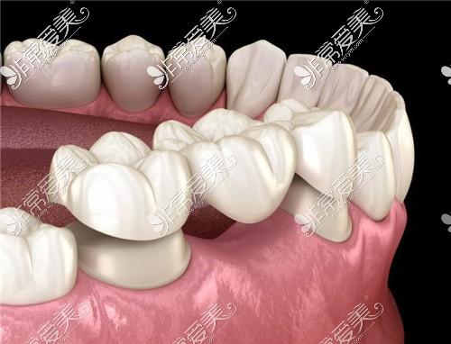 桥冠补牙与种牙有何区别？哪种缺牙修复方式更优？-图3