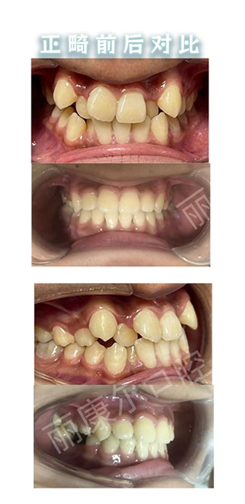 上海在线咨询牙齿正畸，流程、费用和注意事项有哪些？-图1
