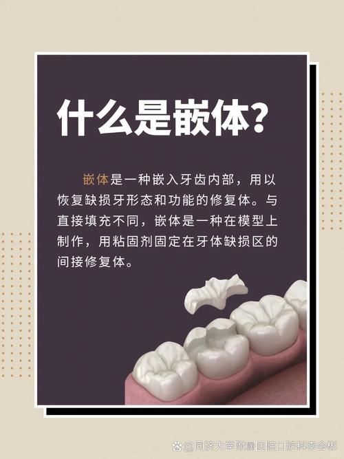 嵌体粘结方法的关键步骤是什么？-图2