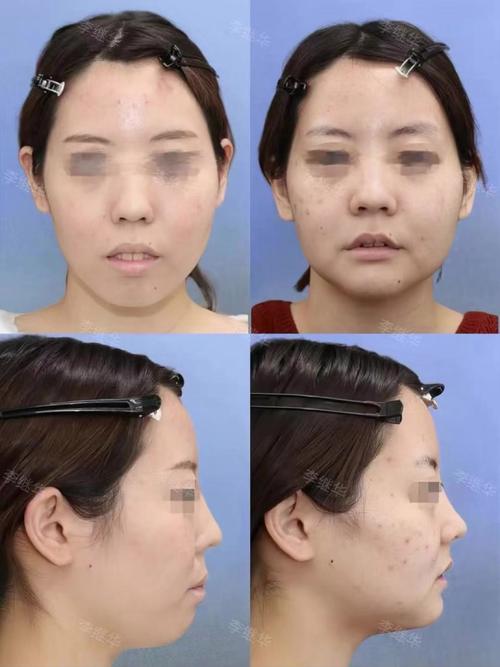 正颌正畸手术前后对比-图1