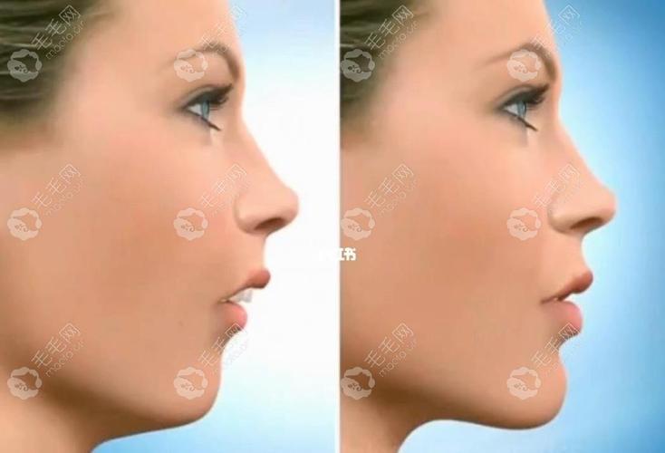 正颌正畸手术前后对比-图3