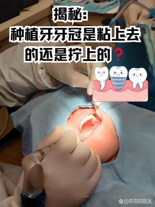 微创种牙结实吗-图2