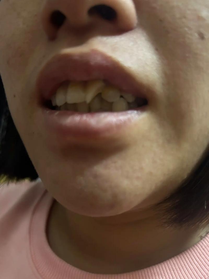 种完牙下巴青了-图2