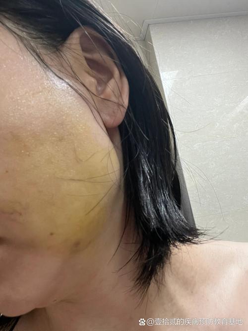 种完牙下巴青了-图1