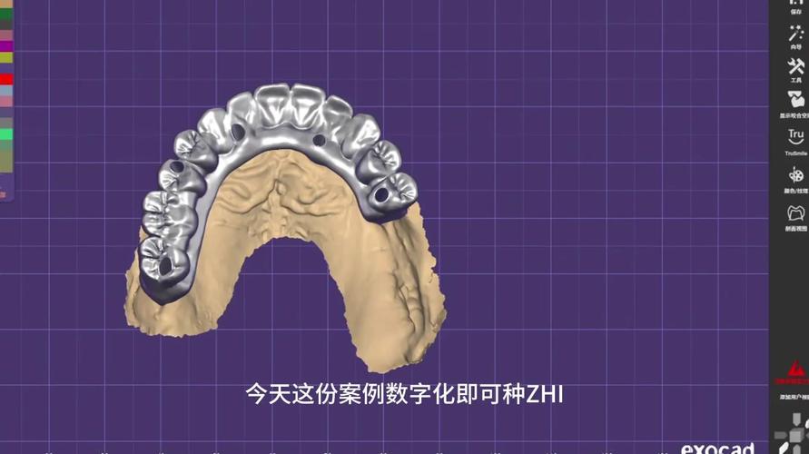 数字化种牙技术如何实现精准高效种植？-图1