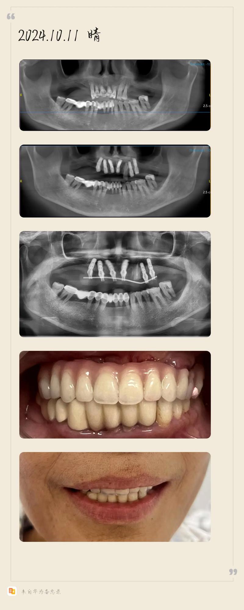 半口牙即种即用靠谱吗？当天种当天用效果如何？-图1