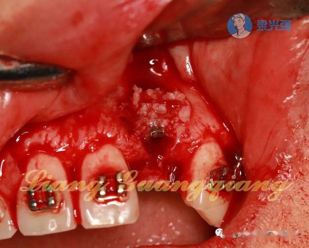 种牙植骨后露出-图2