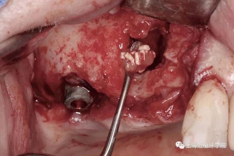 种牙植骨后露出-图3