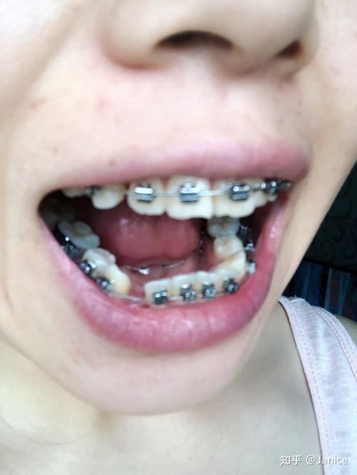 南京市口腔医院 正畸-图2 南京市口腔医院 正畸-图2